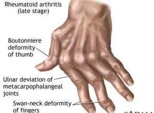 Romatoid Artrit